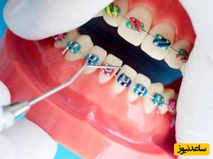 سوالات متداول طول درمان ارتودنسی