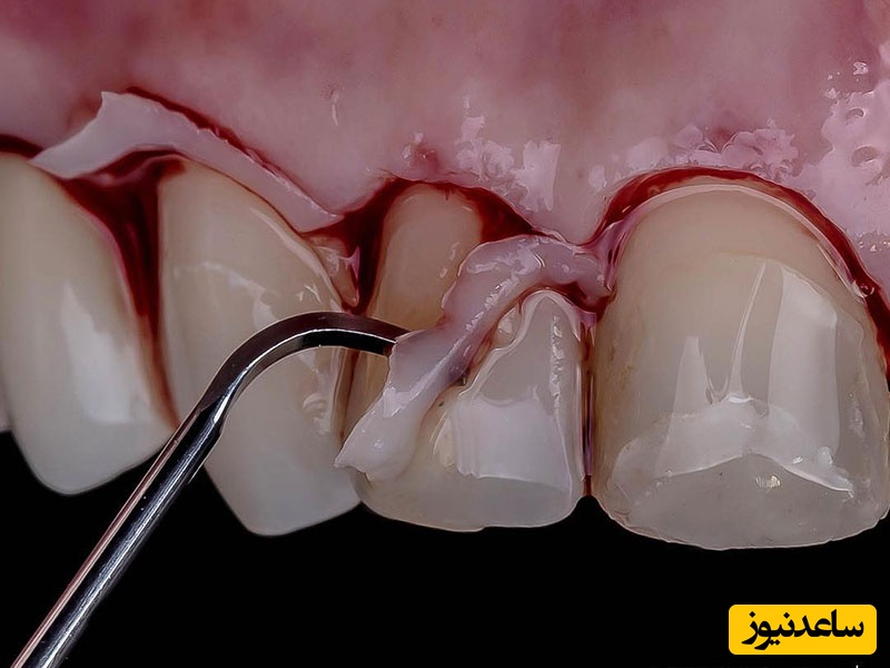 عمل جراحی لثه چیست و چه بیماری هایی را برطرف میکند؟