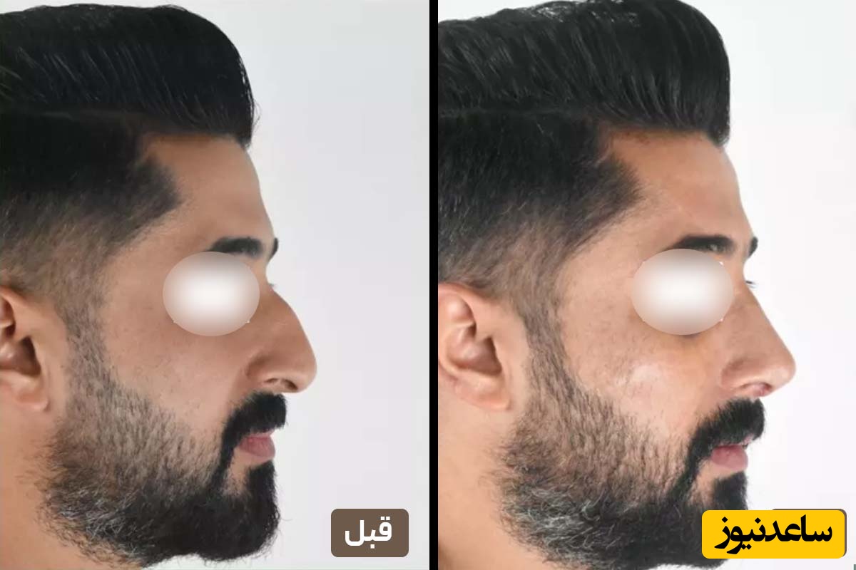 نمونه قبل و بعد عمل بینی بهترین دکترهای عمل بینی در تهران