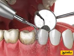 چطور جرم دندان ها را کم کنیم؟