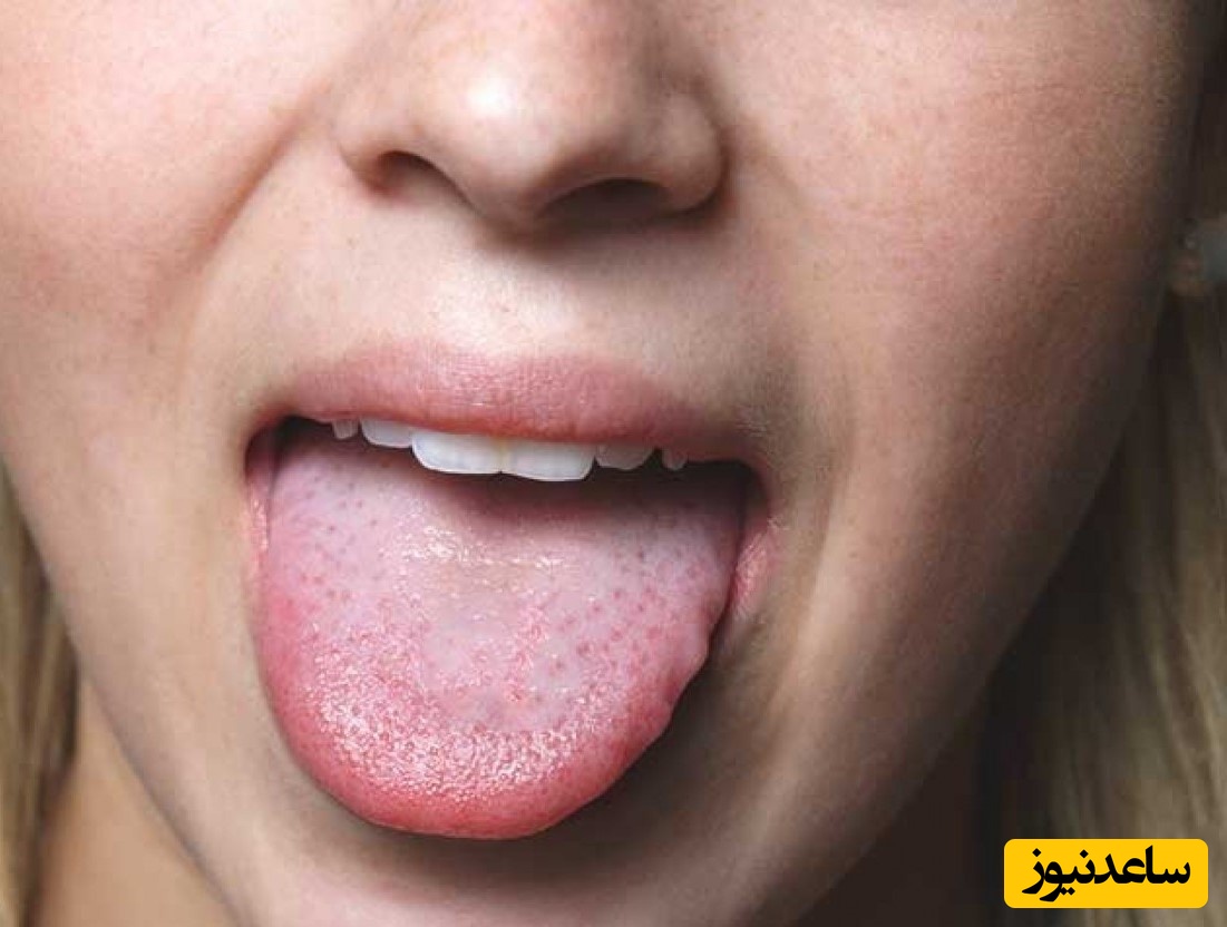 جوش روی زبان می تواند نشان دهنده ی سرطان باشد؟