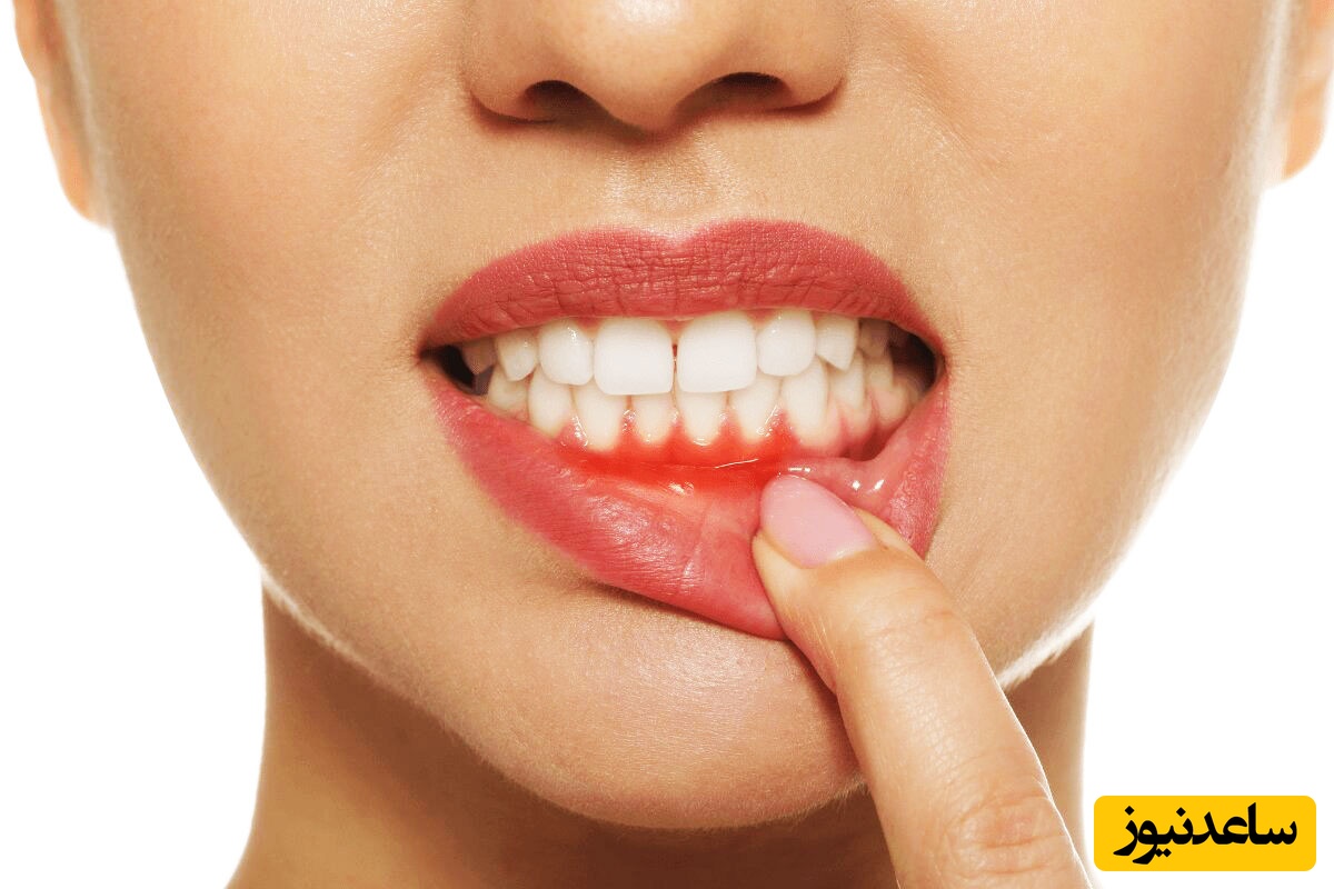 انواع آبسه ی دندان و راه های درمان آن