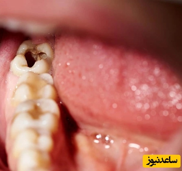 سوالات متداول در مورد عفونت دندان