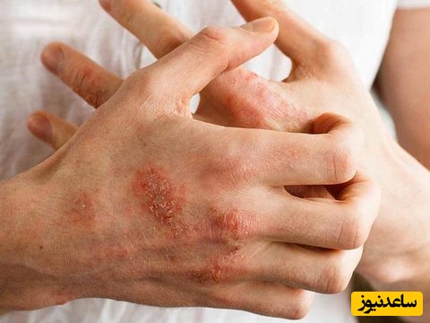 راهنمای کامل مصرف دوپیلومب برای بیماران مبتلا به اگزما