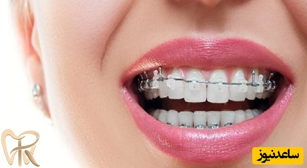 چگونه براکت های سرامیکی می توانند بهترین انتخاب باشند؟