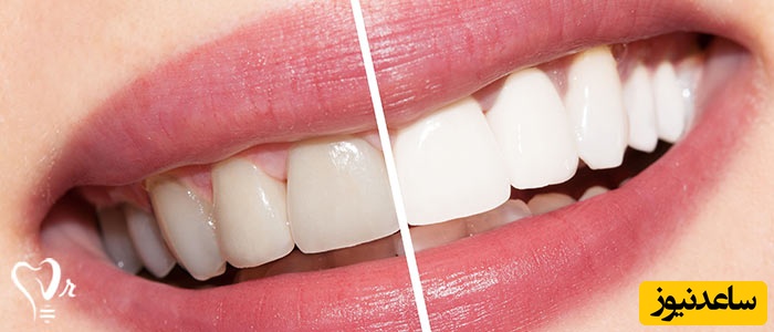 تفاوت کامپوزیت و لمینیت دندان