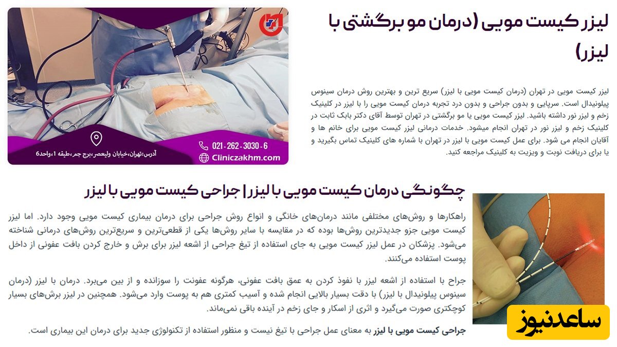 لیزر کیست مویی؛ درمان سینوس پیلونیدال بدون درد و خونریزی