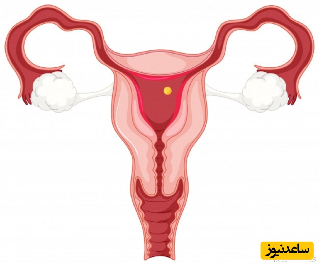 تورشن یا پیچ خوردگی تخمدان چیست و چه علائمی دارد؟