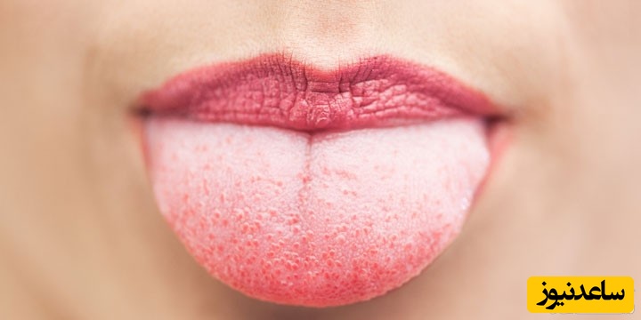 دلایل سفید شدن زبان چیست؟ علل و راه های پیشگیری از آن