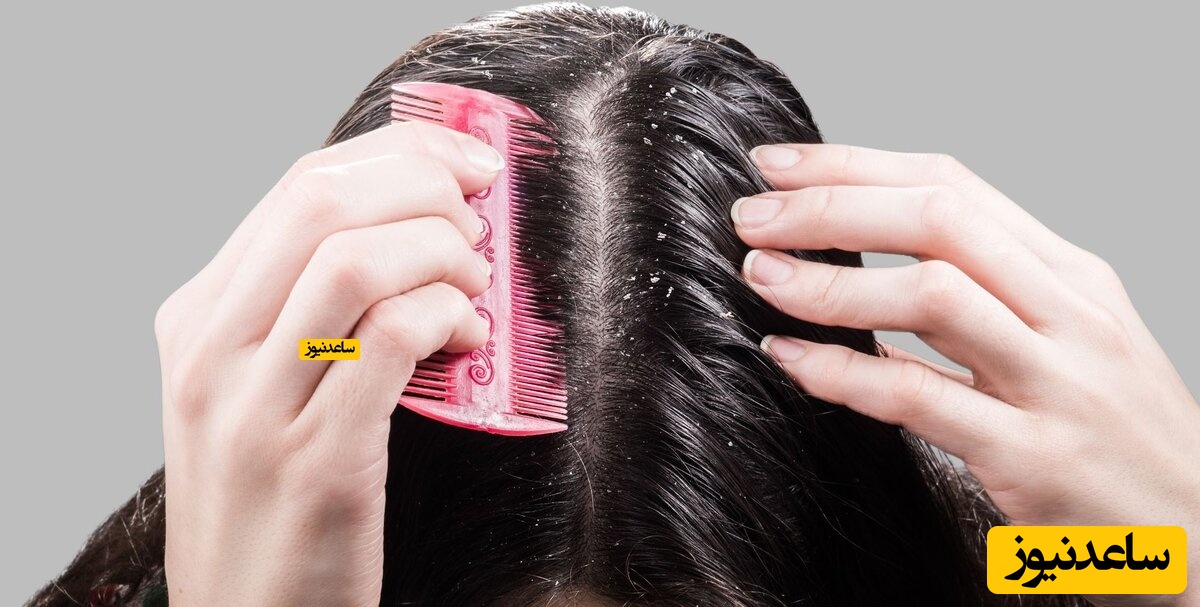 تفاوت شوره سر با خشکی پوست سر!