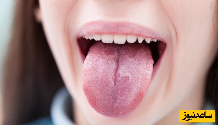 دلایل ابتلا به زبان جغرافیایی چیست؟