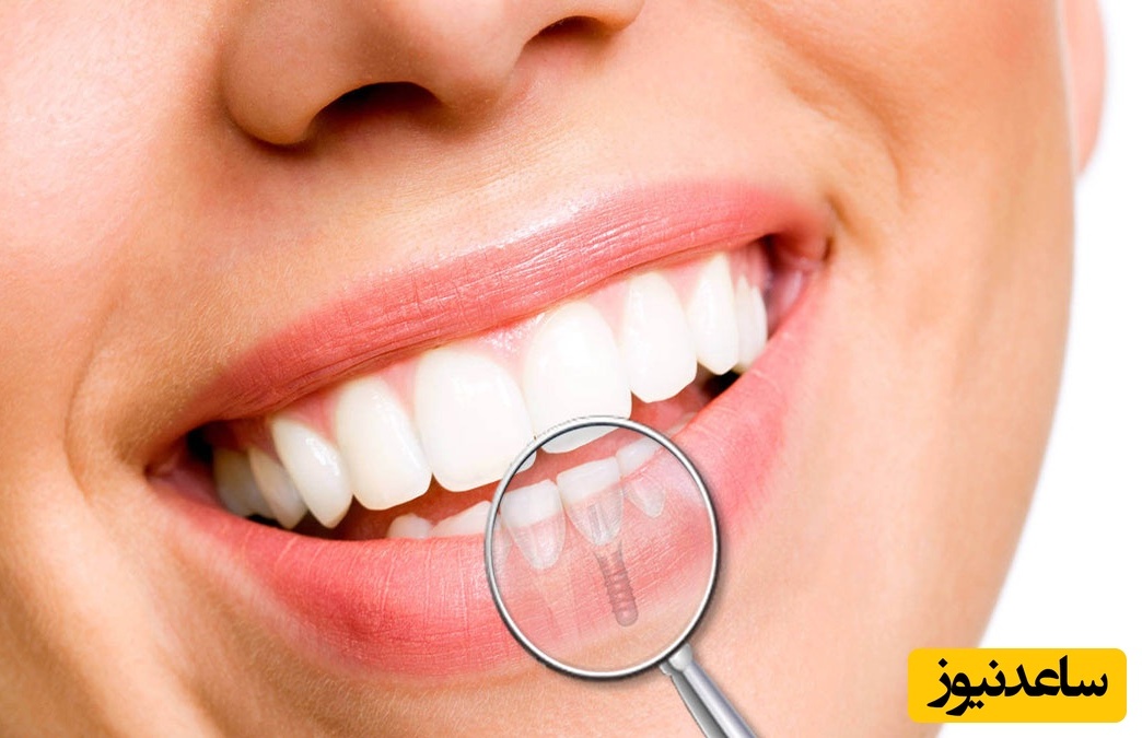 آیا می توان ایمپلنت دندان را ترمیم یا تعویض کرد؟