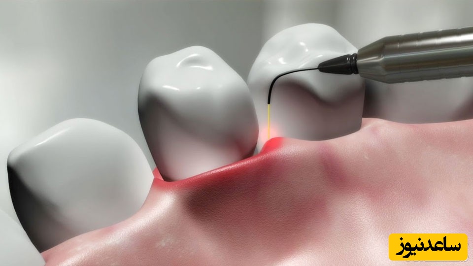 همه چیز در مورد استفاده از لیزر در ایمپلنت دندان