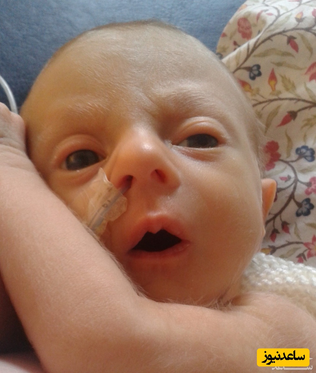 نشانه های سندرم ادوارد یا  تریزومی 18 در کودکان