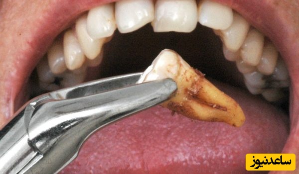 مراحل کشیدن دندان چگونه است؟