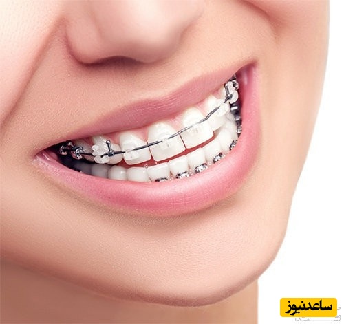 فشار خون بالا و امکان ارتودنسی