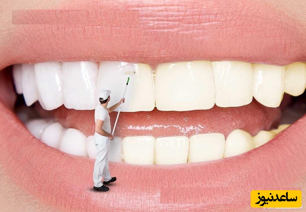 بهترین روش برای سفیدی دندان ها در طب سنتی