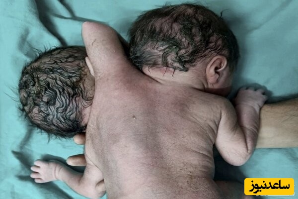 تصاویر باورنکردنی| عجیبترین نوزادی که در هند زاده شد