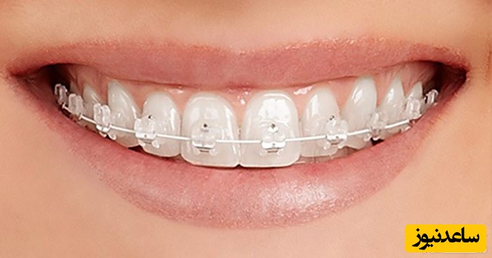 اورتودنسی سرامیکی