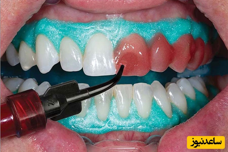 بلیچینگ دندان پس از درمان ارتودنسی لازم است؟