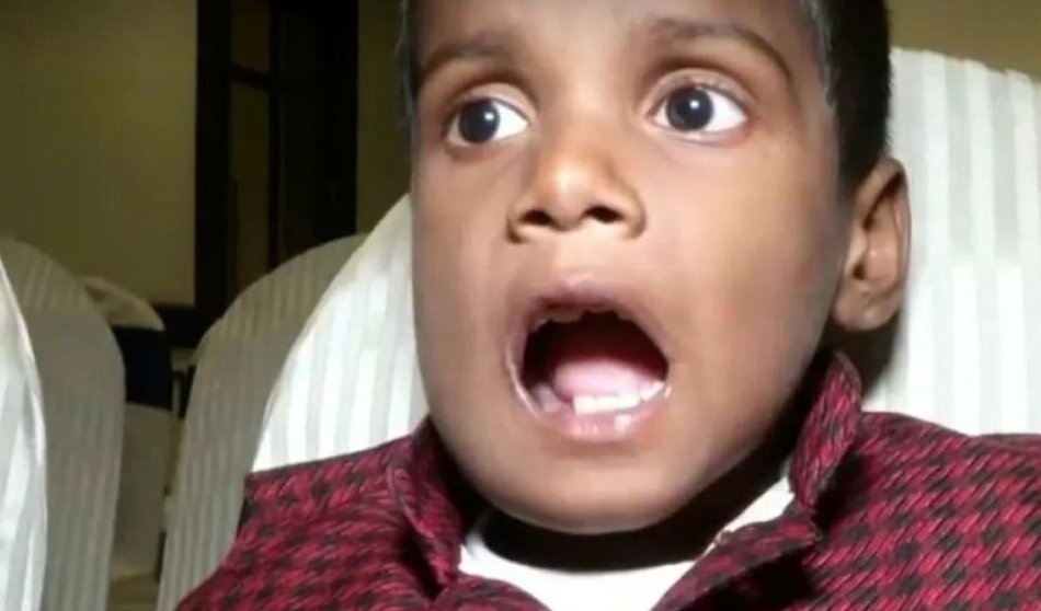 (ویدئو) بیرون کشیدن 526 دندان اضافی از فک کودک 7 ساله