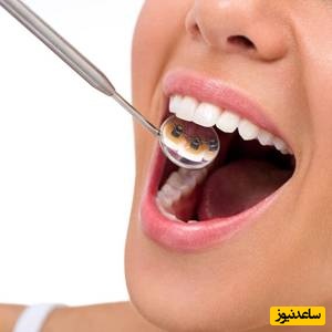 ارتودنسی لینگوال و نکات مهم در مورد آن