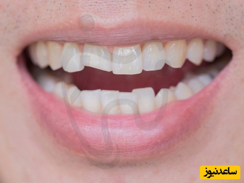 دندان شکسته را به حال خود رها نکنید!