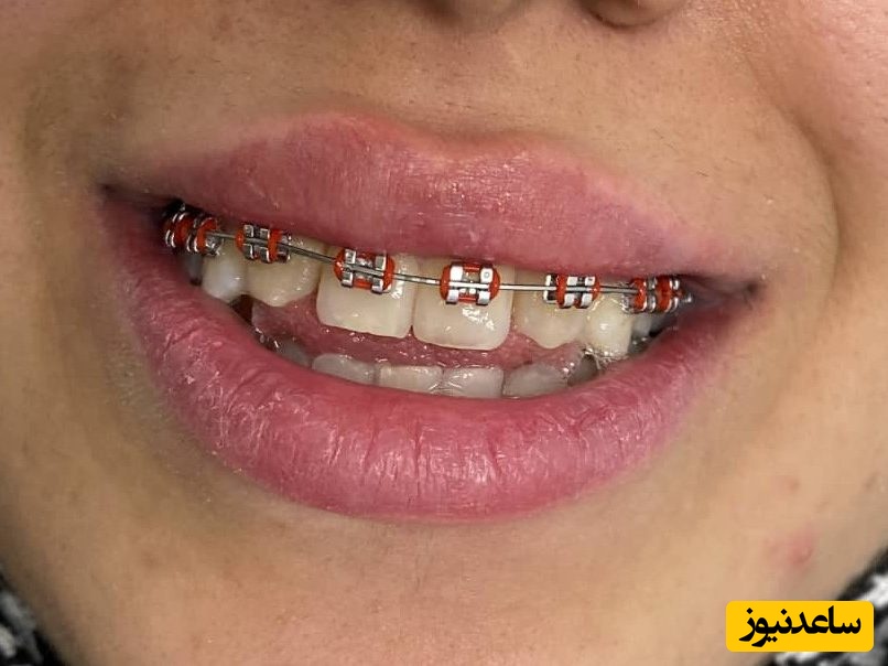 مهمترین مراحل ارتودنسی ثابت چیست؟