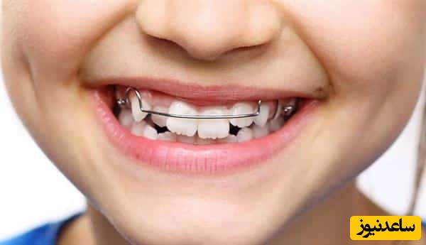 درمان مال اکلوژن در ارتودنسی