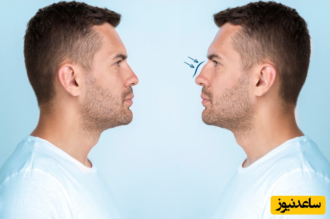 عمل بینی اقساطی توسط دکتر مجید نصیری در کلینیک زیبایی نورسا