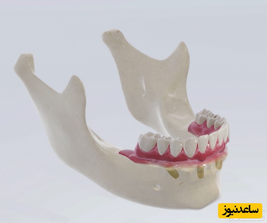 دندان مصنوعی فوری چیست؟