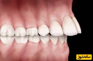 جلو زدگی دندان های بالا + نکات مهم