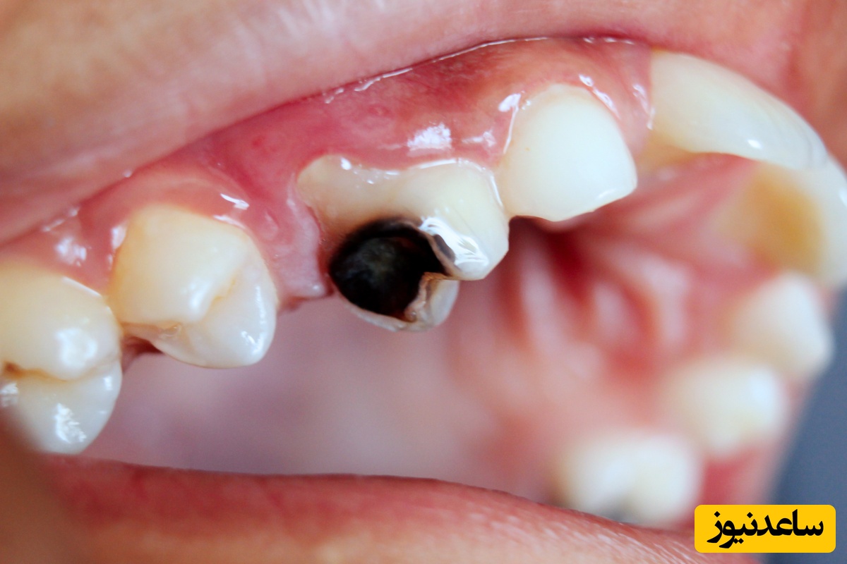 ایا پوسیدگی دندان میتواند ژنتیکی باشد؟