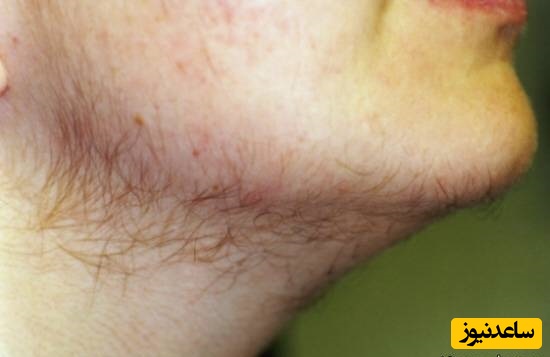 افزایش هورمون مردانه در زنان؛ علائم، دلایل و جدیدترین روش‌های درمانی