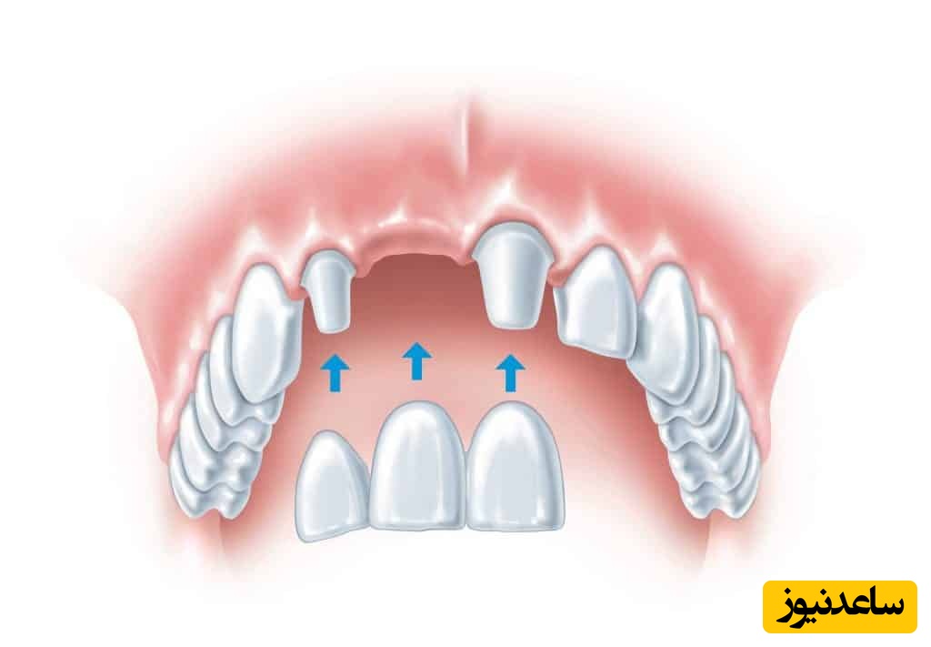 مزایای کاشت فوری دندان چیست؟