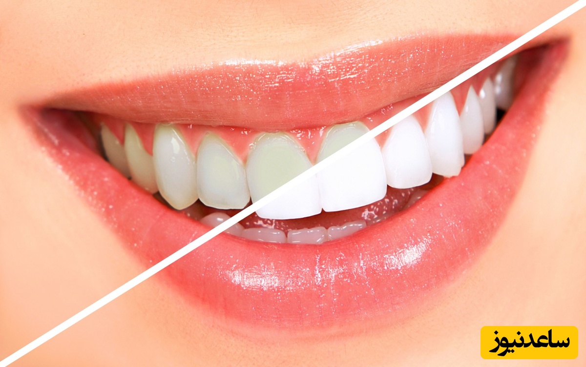 آیا دندان‌های درخشان تر و سفیدتر می‌خواهید؟