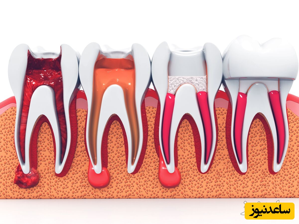 علائم پوسیدگی ریشه دندان