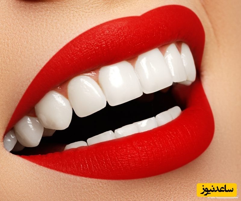 لمینت دندان چیست و برای چه افرادی مناسب است؟