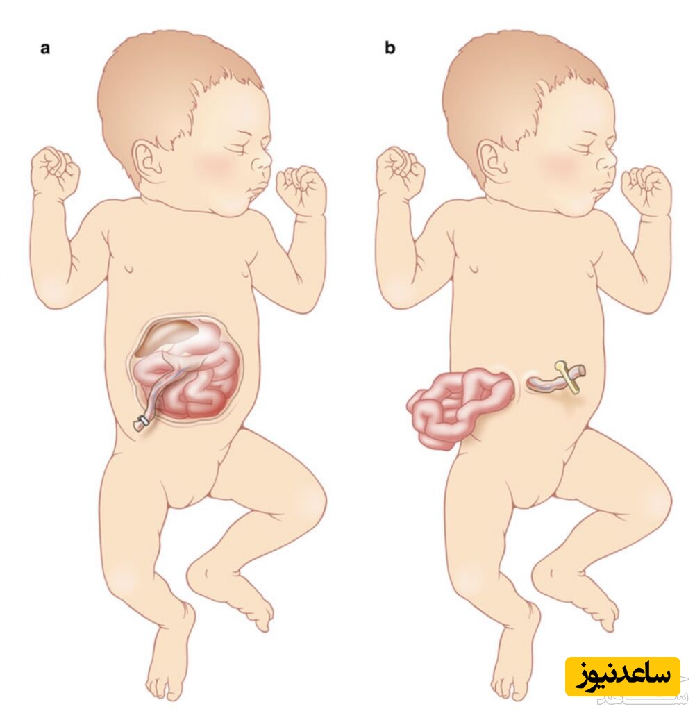 علل و عوامل امفالوسل جنین در بارداری