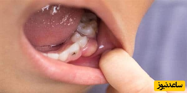 درمان های خانگی برای عفونت دندان کشیده شده