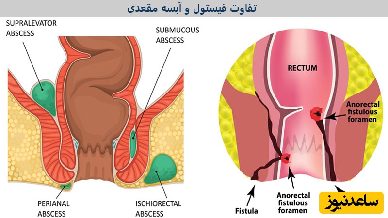 انواع فیستول و عفونت مقعد در صورت عدم درمان به موقع!