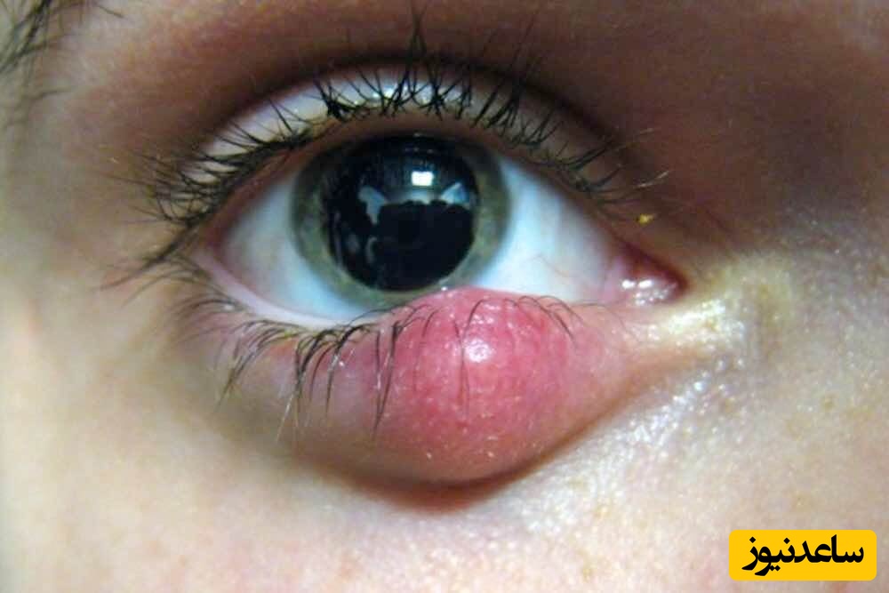 درمان فوری و قطعی شالازیون چشم با گنجینه طب سنتی و گیاهان دارویی