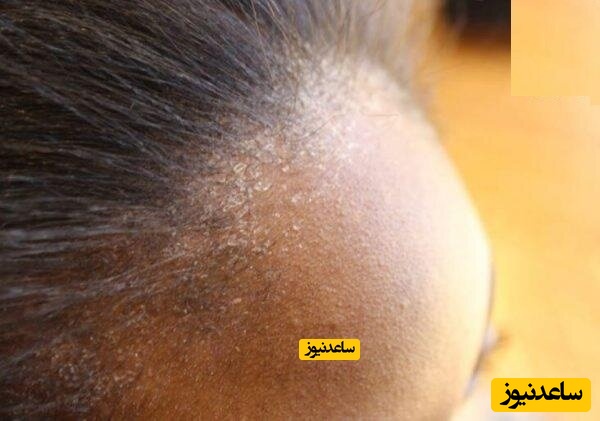 پوستر خشکی پوست سر