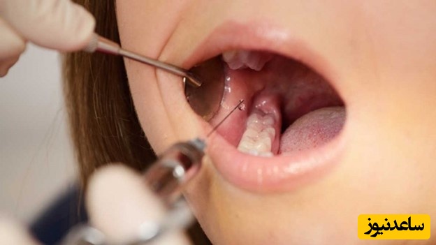 عوارض بی حسی در دندانپزشکی