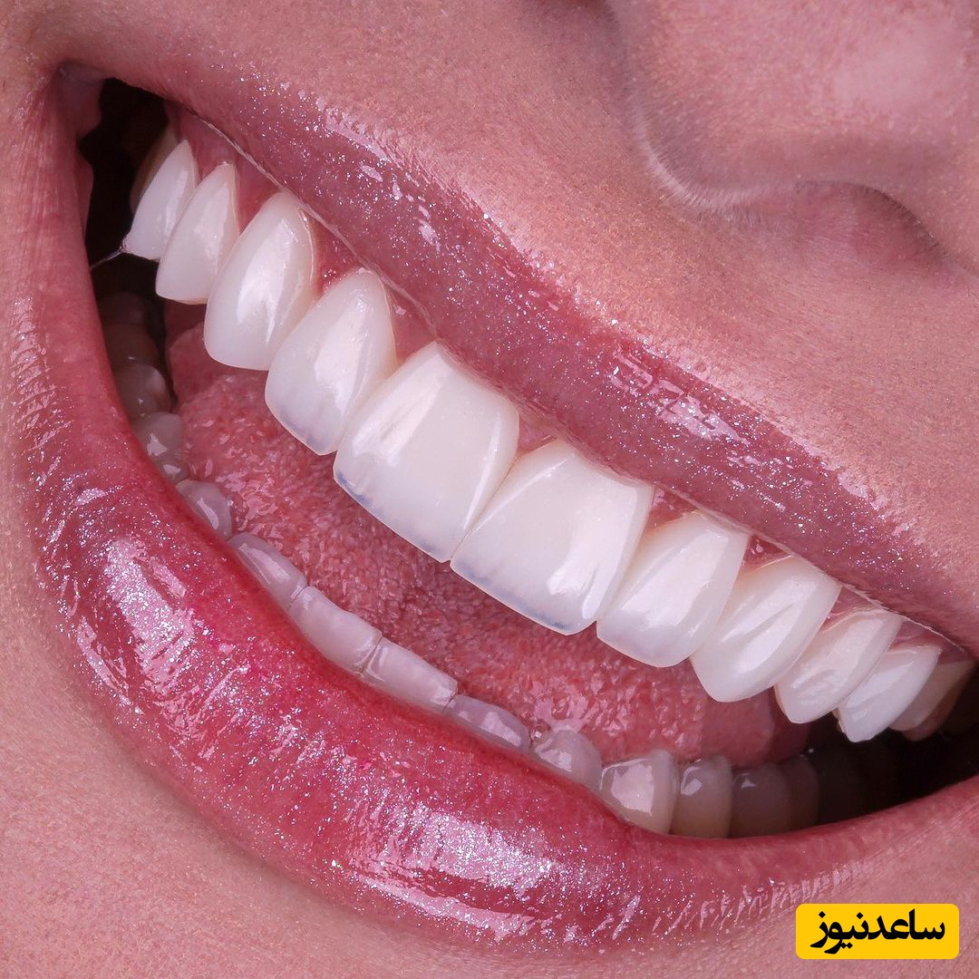 چگونه لبخندی جذاب داشته باشیم؟