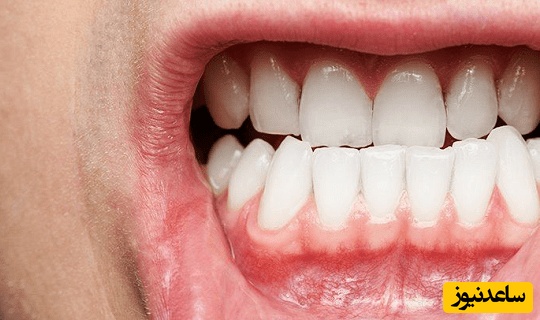 درمان ریشه ی دندان چگونه است؟