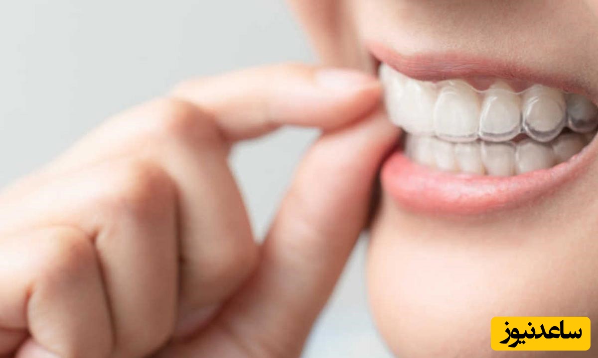 مزایای فوق العاده ی ارتودنسی دیمون چیست؟