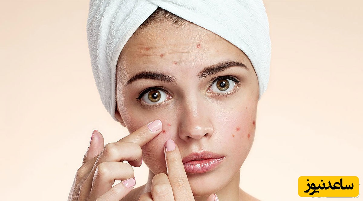 آیا رابطه جنسی باعث بروز جوش و آکنه می‌شود؟