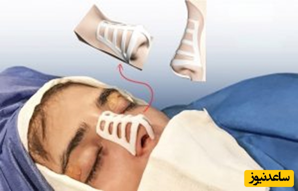 مراقبت‌های قبل و بعد از رینوپلاستی