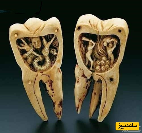 کرم خوردگی دندان یا حفره ی دندان